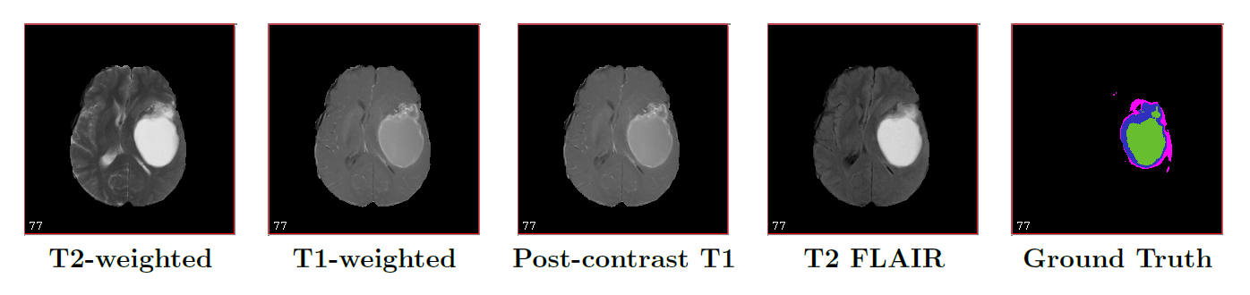 Multimodal Brain Tumor Segmentation and Survival Prediction | Chenyu Gao